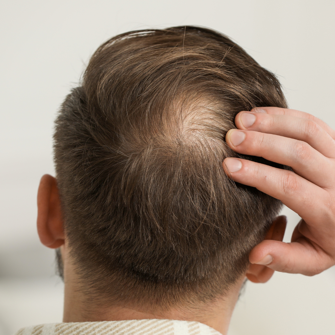 DHT Blocker vs Minoxidil : quelles différences ? – MakeMyMask