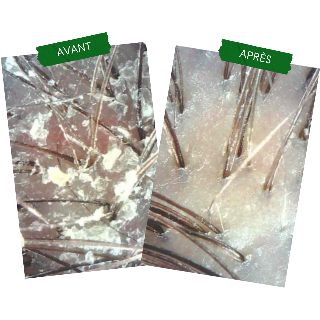 Concentré Anti-PSO & Plaques