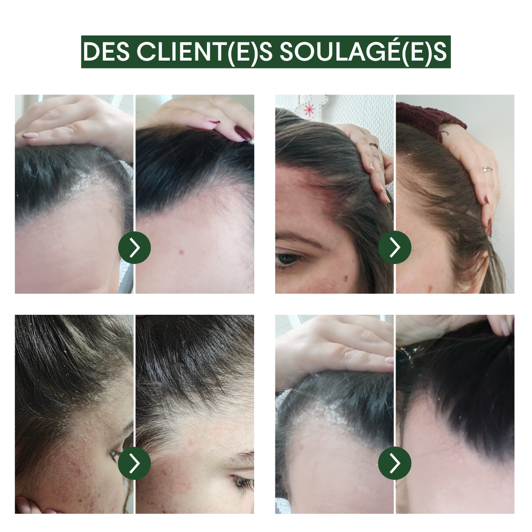 Protocole Anti-PSO & Plaques