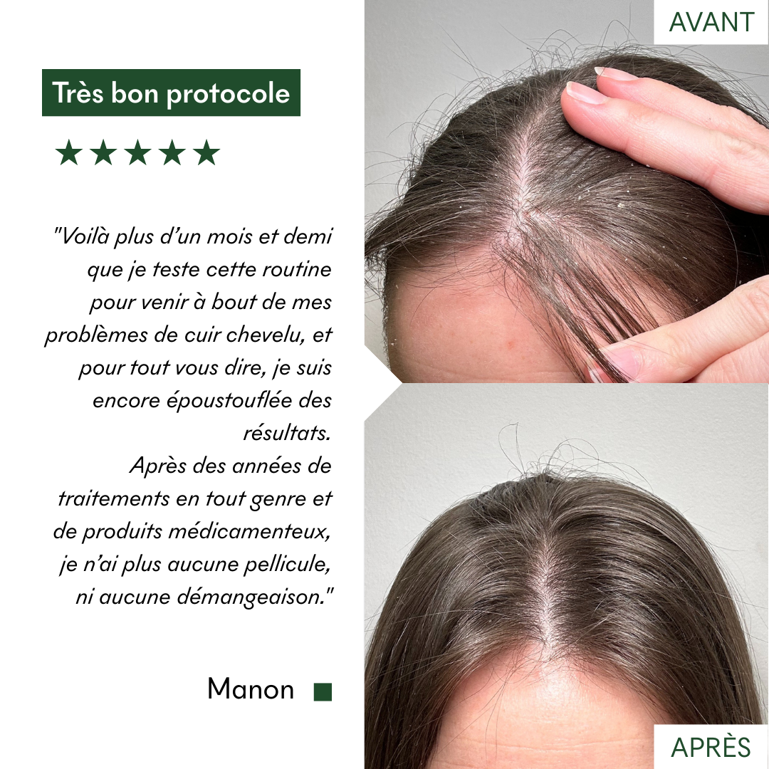 Très bon protocole anti-pellicules grasses & dermatite séborrhéique de MakeMyMask, voici mon avant-après
