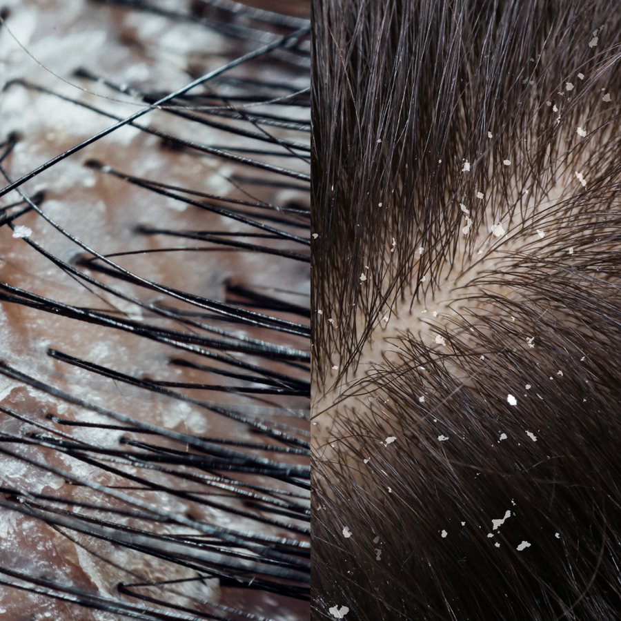 Pellicules sèches VS pellicules grasses : comment les reconnaître ?