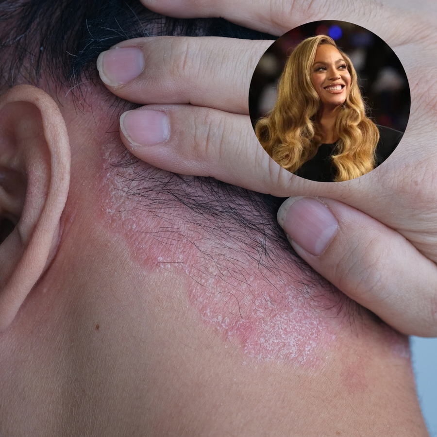 Beyoncé and scalp psoriasis: what you need to know