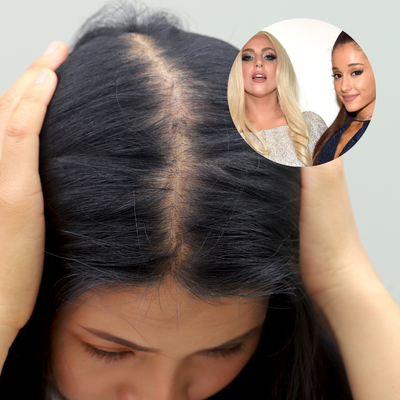 Ariana Grande, Lady Gaga : cheveux abîmés ou alopécie androgénétique ?