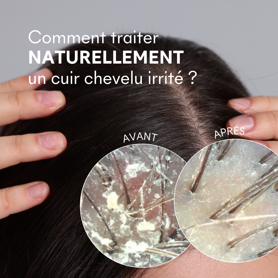 Wie behandelt man gereizte Kopfhaut auf natürliche Weise? –MakeMyMask