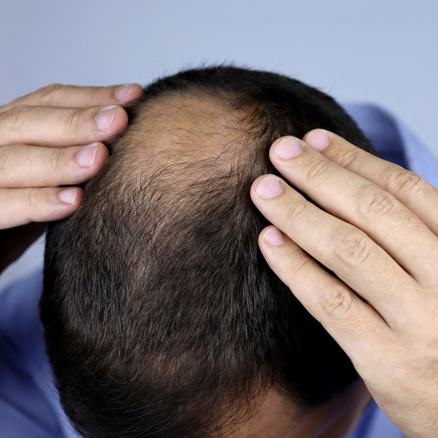 DHT Blocker : la solution naturelle contre la chute de cheveux hormonale