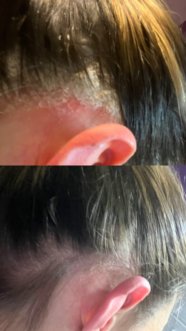 PSORIASIS