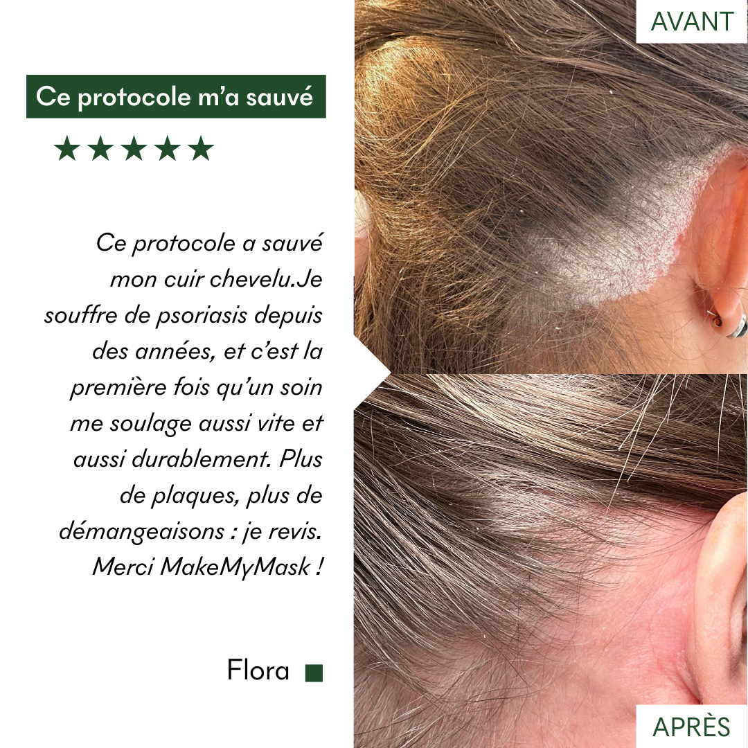 Questo protocollo anti-psoriasi e contro le zone secche di MakeMyMask ha salvato il mio cuoio capelluto, ecco il mio prima e dopo
