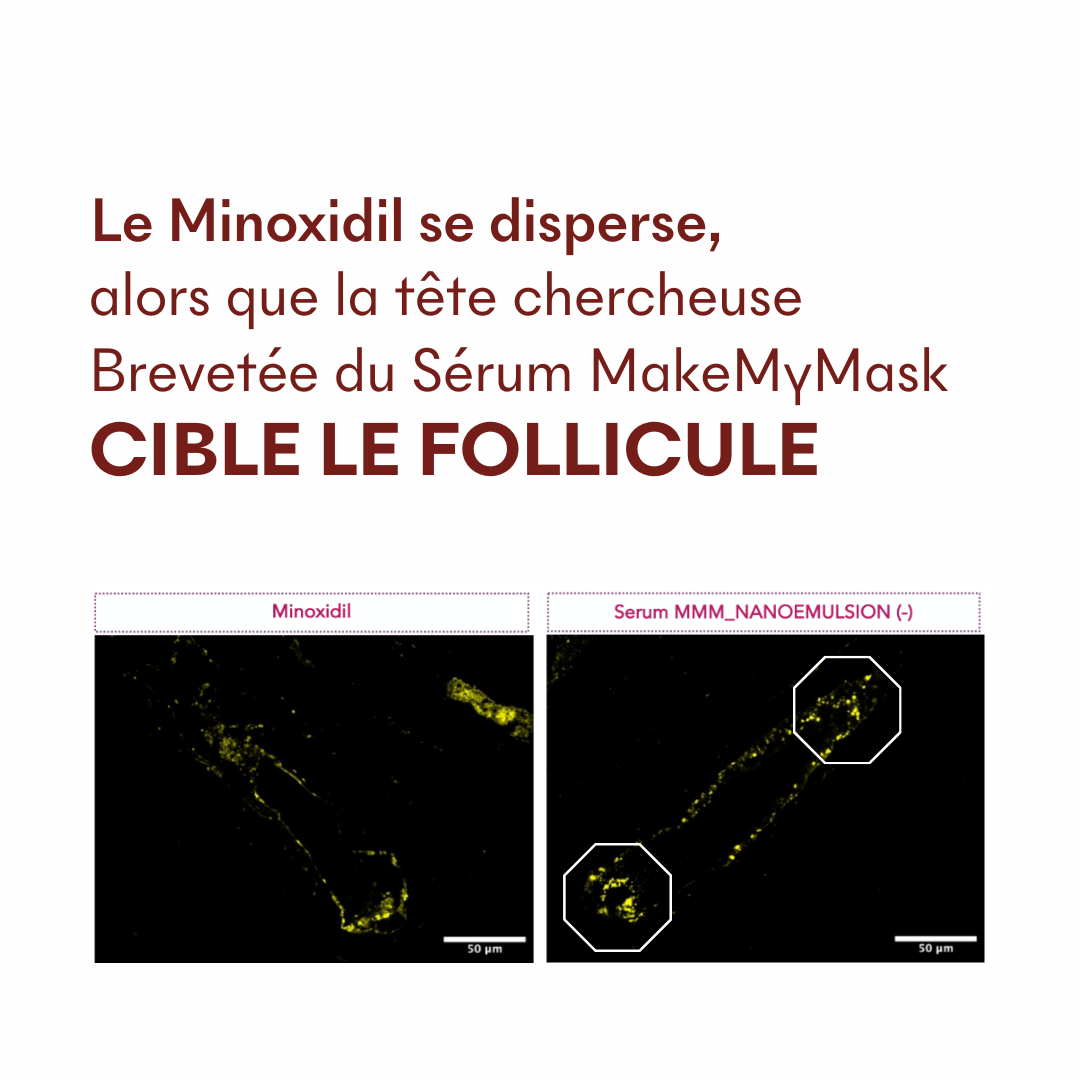 Protocole Alopécie Androgénique Féminine