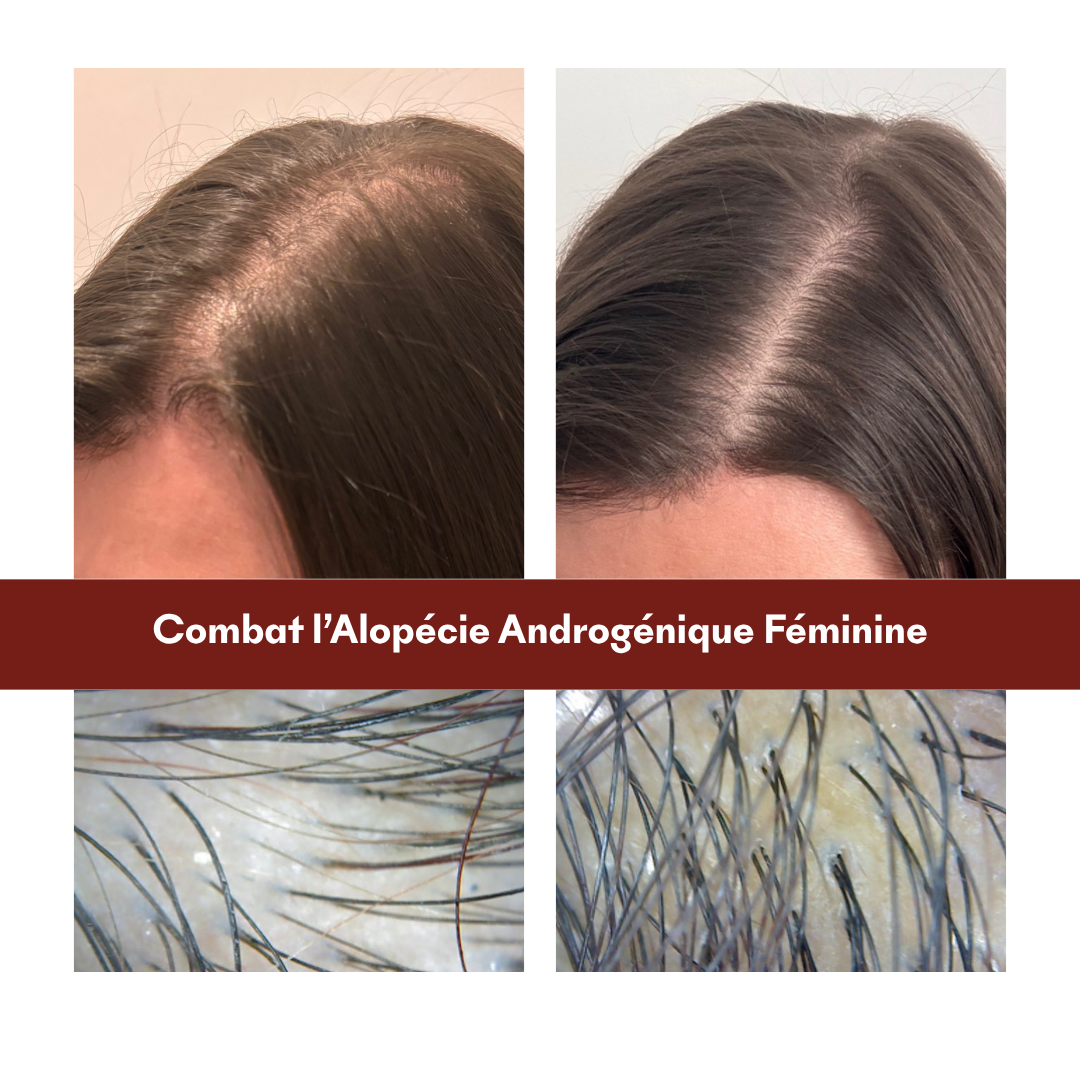 Protocole Alopécie Androgénique Féminine