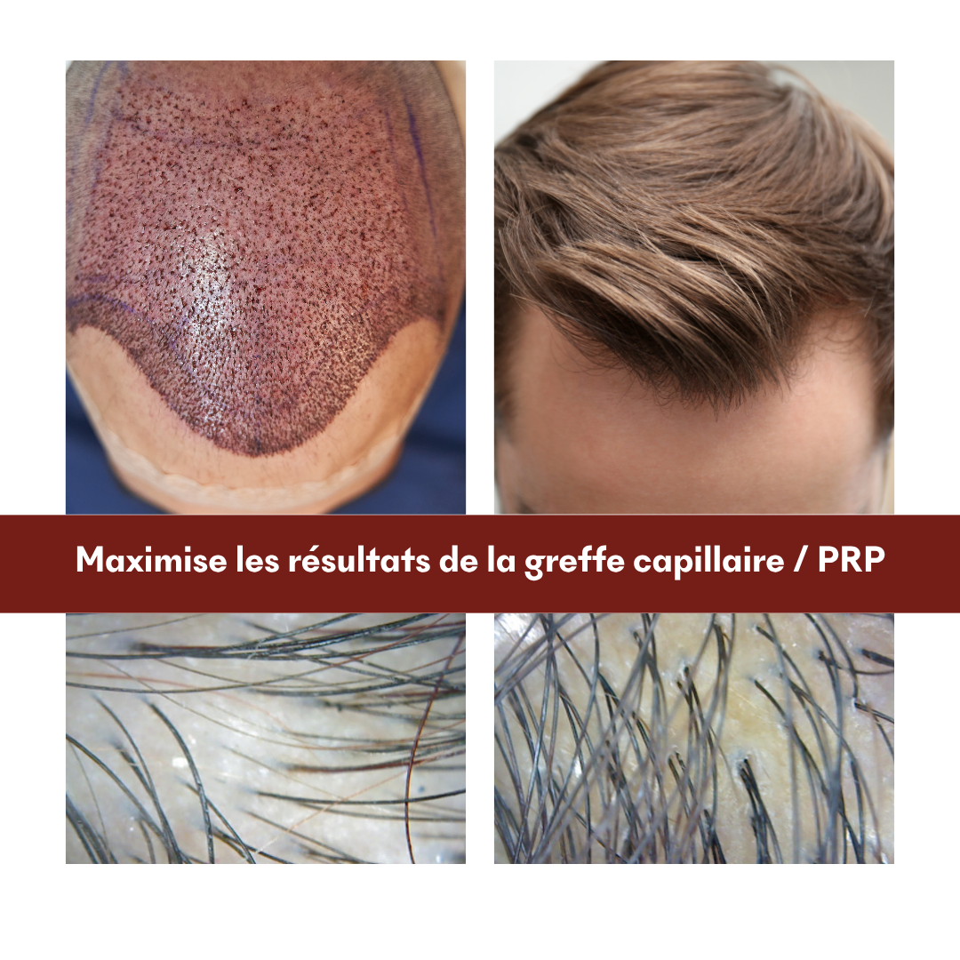 Mallette Post-Greffe/PRP