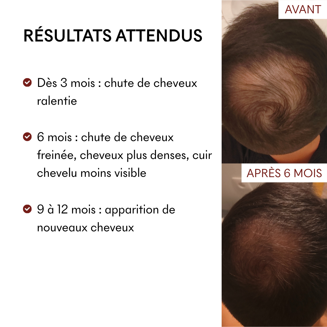 DHT Blocker Anti-Chute Hormonale 3 MOIS