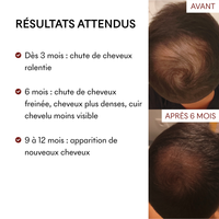 DHT Blocker Anti-Chute Hormonale 3 MOIS