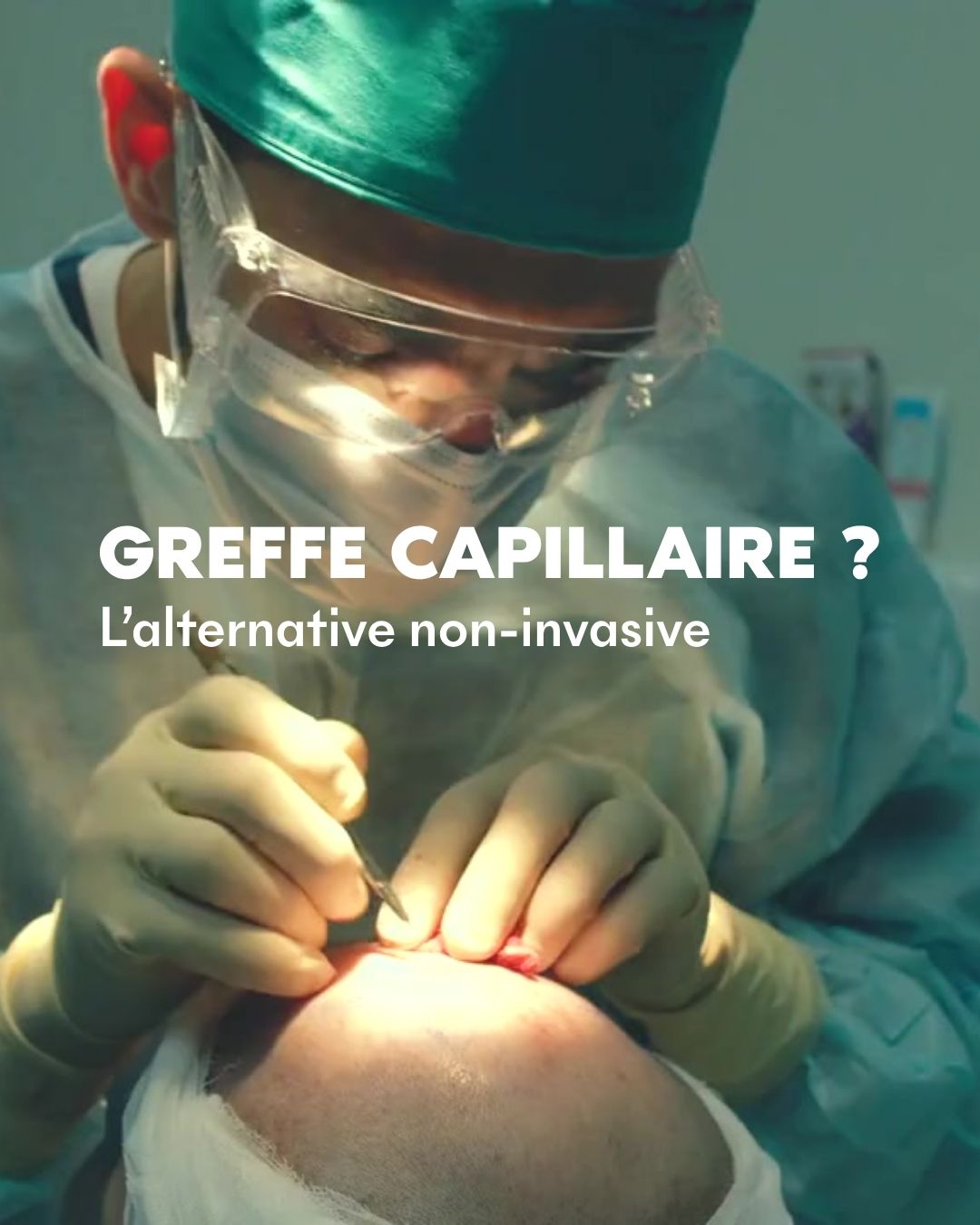 A TRUE ALTERNATIVE TO HAIR TRANSPLANTS