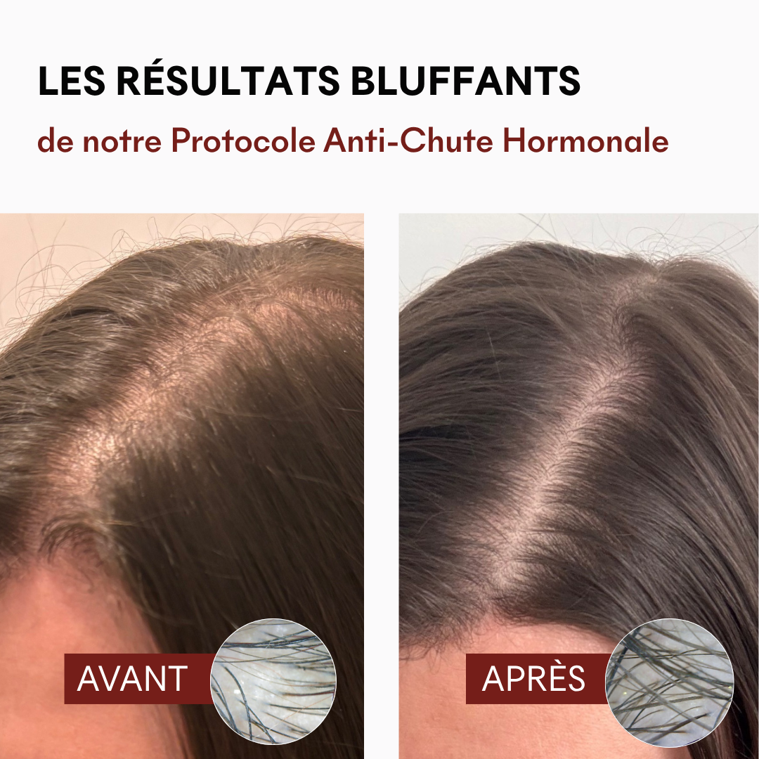 DHT Blocker Anti-Chute Hormonale 3 MOIS