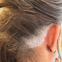 E-Book Psoriasis