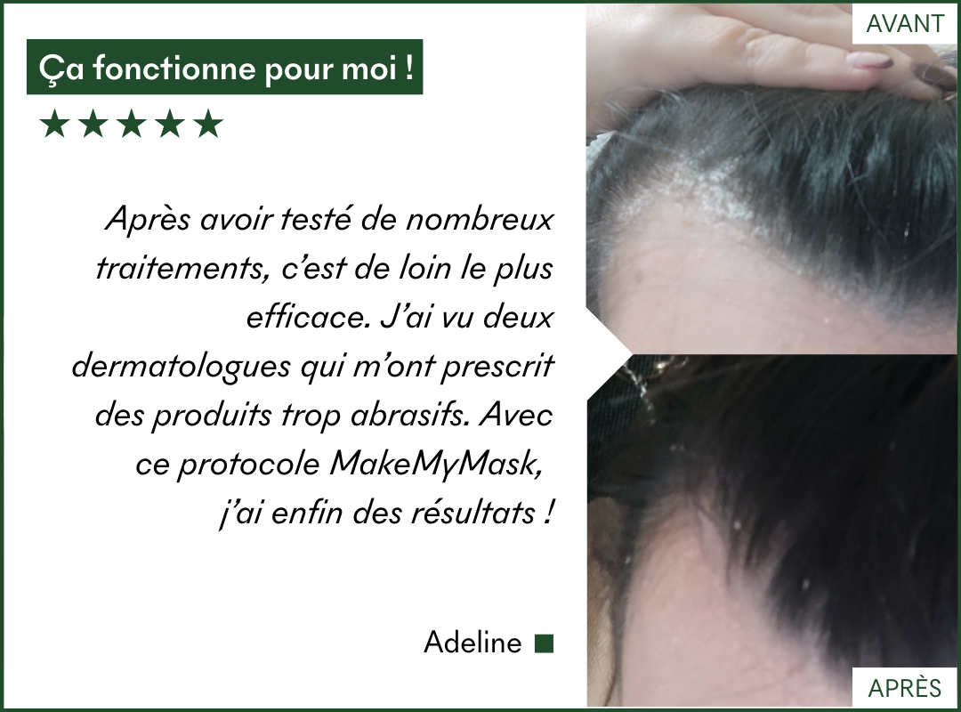 Le protocole Anti-PSO & Plaques de MakeMyMask fonctionne sur mon psoriasis et mes plaques sèches, voici mon avant-après